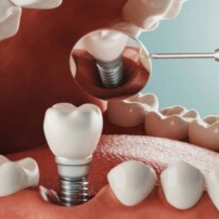 implant-tedavisi-nedir-nasil-yapilir-tedavi-ne-kadar-surer-320x202