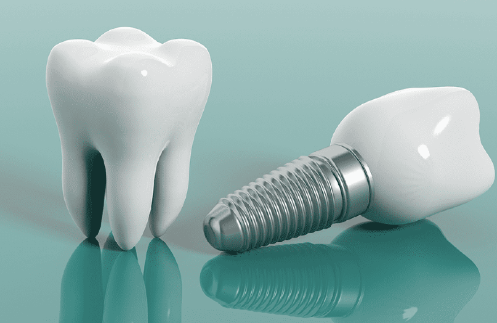 nisantasi-implant-tedavisi